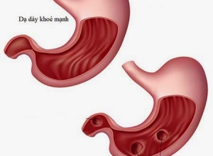 Viêm hang vị dạ dày có nguy hiểm không?